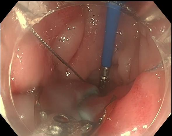 endofaster内镜机器人辅助esd术后创面闭合