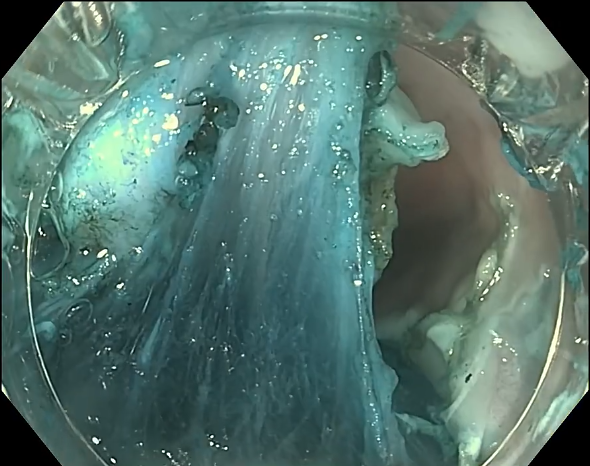 endofaster内镜机器人辅助食管esd（调整牵引点位全程保持黏膜下层暴露）