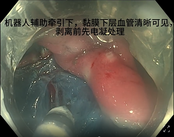 endofaster内镜机器人辅助胃esd（粘膜下血管处理）