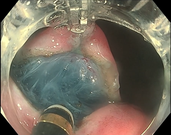 endofaster内镜机器人辅助胃窦大弯侧大范围病变行esd