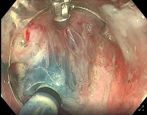 endofaster内镜机器人辅助胃体后壁大病变行esd