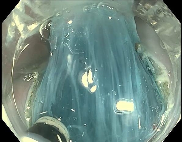 endofaster内镜机器人辅助食管下段病变行esd